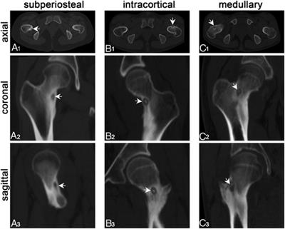 Osteoid Osteoma of the Proximal Femur: Pitfalls in Diagnosis and Performance of Open Surgical Resection